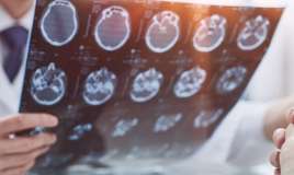 İnsultun müayinə və müalicəsi icbari tibbi sığorta ilə qarşılanır 