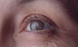 Gözlə beyin arasında əlaqənin pozulduğu xəstəlik 