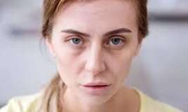 Bir baxışla qanazlığı diaqnozu qoymaq olmaz 