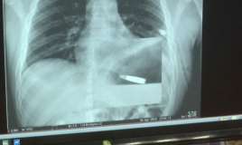 Ürəyinə güllə keçən kişi əməliyyat olundu 