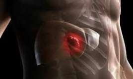  Güclü bel ağrısı qaraciyər xərçəngindən  ola bilər