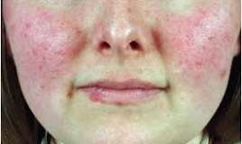 Doktor Hausun sevdiyi xəstəlik  – Qırmızı qurd eşənəyi necə görünür?