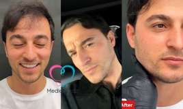 İqo üzünə estetik prosedur etdirdi -  VİDEO