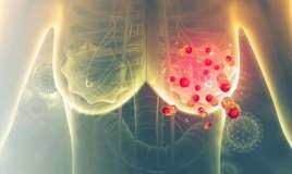 Süd vəzi xərçəngi xəstələrində   -  Venadaxili vitamin C-nin təsiri