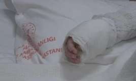 Körpənin üstünə qaynar su töküldü:  Bədəninin 27%-i yandı 