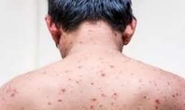 Rusiyada meymunçiçəyinə yoluxma aşkarlandı 