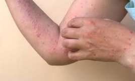 Meymunçiçəyinə yoluxmuş şəxsdən xəbər var 