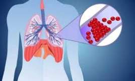 Ağciyər emboliyasını müalicəsi  edən cihaz    - kəşf edildi