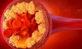 Pis" xolesterolu 60% azaldan dərman kəşf edildi 