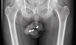 Penisində batareya ilişib qalan kişi     -  əməliyyat olundu