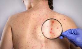 Orta Asiyada sifilis, bruselyoz tüğyan edir 