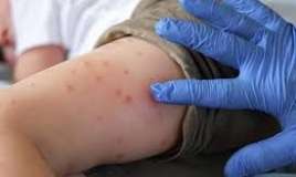 Ermənistanda çikunqunya virusu aşkarlandı 