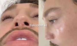 4 dəfə uğursuz əməliyyat etdirən stilist   - Həkimləri ifşa etdi - Adlar