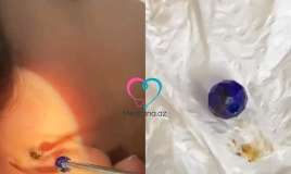 Uşağın qulağından muncuq çıxdı -  Həkimdən xəbərdarlıq-VİDEO