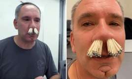  Təcili yardım həkimi burnuna 91 kibrit saldı 