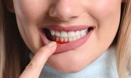 Təbii müalicə -   Diş ətlərinə bal çəkmək sizi diş həkimindən xilas edir