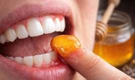 Təbii müalicə -   Diş ətlərinə bal çəkmək sizi diş həkimindən xilas edir