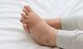 Ayaqların qəfil şişməsi qaraciyərdən ola bilər 