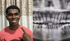 Kişinin ağzında 42 diş çıxıb 