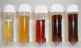 Sidiyin bu rəngi qaraciyərin ağır zədələndiyini göstərir 