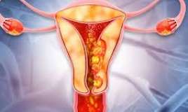 Yaşlı qadınlarda uşaqlıq qanaması -  Endometrium Qalınlaşması (Hiperplaziya)