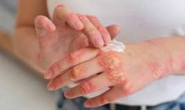 Ekzemaya qarşı krem resepti -  Dərini nəmləndirir