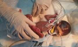 1 kiloqramlıq körpənin ürəyi     əməliyyat olundu