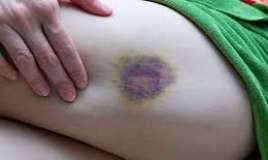 Bədəndə göyərmə, qançırlar sağalmır?   – Bu orqanı yoxlat