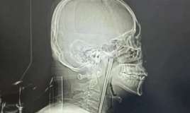 Yemək çubuğunu udan kişi 8 il həkimə getməyib 