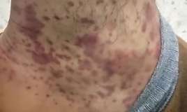 Qan durulaşdırıcı dərmanlardan ayağı bu hala düşdü -  VİDEO