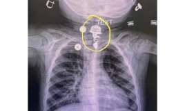 16 aylıq uşaq boyunbağı uddu -  FOTO