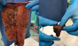 Vaginaya salfet qoyan qadın ağır infeksiyaya yoluxdu -  VİDEO