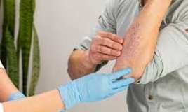 Psoriaz və göbələyin yeni müalicəsi    tapıldı