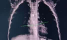 2 yaşlı uşaq yağ çözücü içdi - Daxili orqanları yandı -  VİDEO