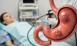 Bu qidalar mədə xərçəngini artırır 