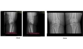 Protez təklif edildi, amma əməliyyatsız sağaldı –  Real pasiyent hekayəsi-VİDEO