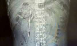 Uşaq vaxtı udduğu termometr  – 20 il sonra çıxarıldı