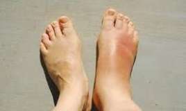 Topuq nahiyəsində şişkinlik və ağrı   - Səbəblər