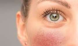 Qırmızı sifət  – Ürəyin xəstə olduğunu göstərir