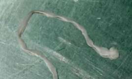 Qadının beynindən 8 santimetrlik    qurd çıxarıldı