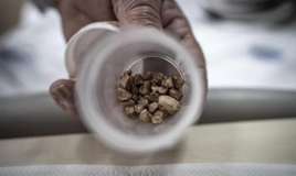 Qadının sidik kanalından 51 daş çıxarıldı -  Həkimlər şokda