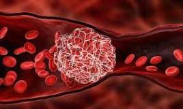 Trombun damardan qopmasının    əlamətləri 