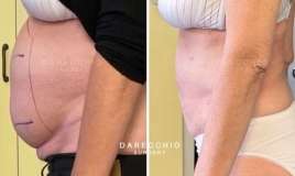  Qadının qarnı önə doğru çıxırsa... -   Səbəbləri - VİDEO