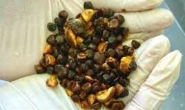 Öd kisəsində daş yaradan qaydalar 