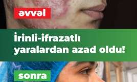 İltihablı sızanaqlar yeniyetmənin həyatını alt-üst etmişdi.  İnteqrativ müalicə ilə həll yolu tapıldı - VİDEO