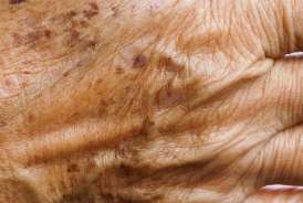 Gündə bir dəfə sürtün -  Qocalıq ləkələrini yox edir