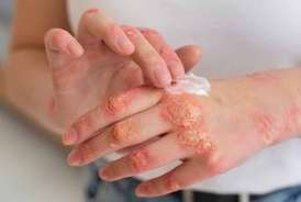 Ekzemaya qarşı krem resepti -  Dərini nəmləndirir