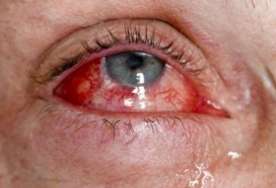 "Qırmızı göz" epidemiyası sürətlə yayılır 