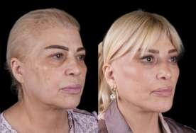 Mətanət İsgəndərlinin dəyişimi gündəm oldu -  FOTO