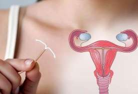 Spiral xərçəngə səbəb olur?  – Ginekoloqdan cavab